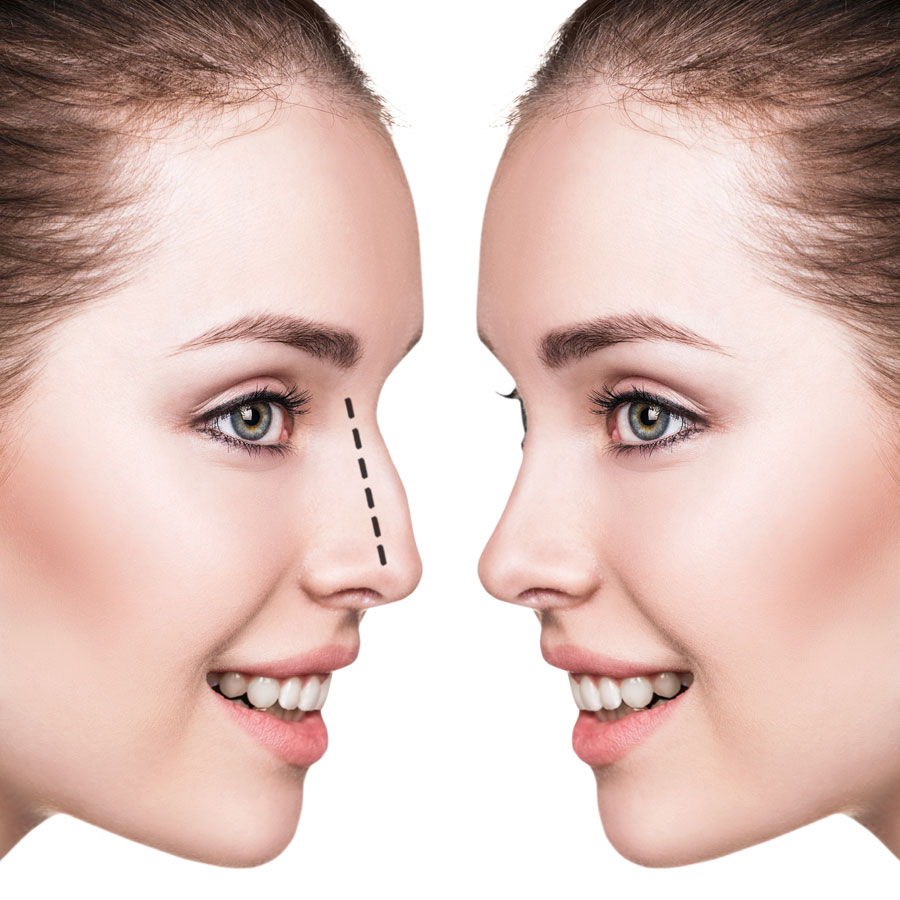 Non Surgical Rhinoplasty Essex - Enhance Me Aesthetics